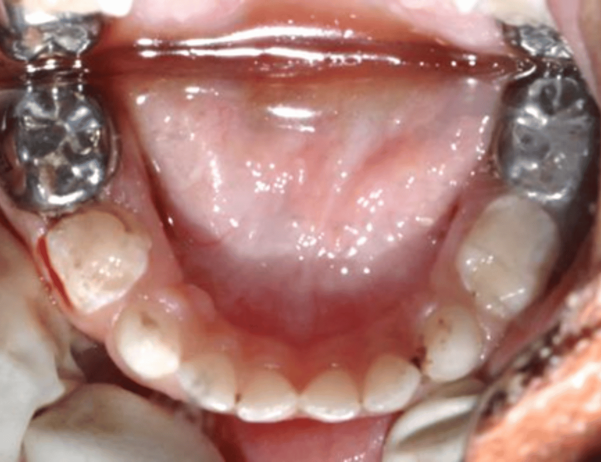 Complete Oral Rehabilitation under General Anasthesia-after