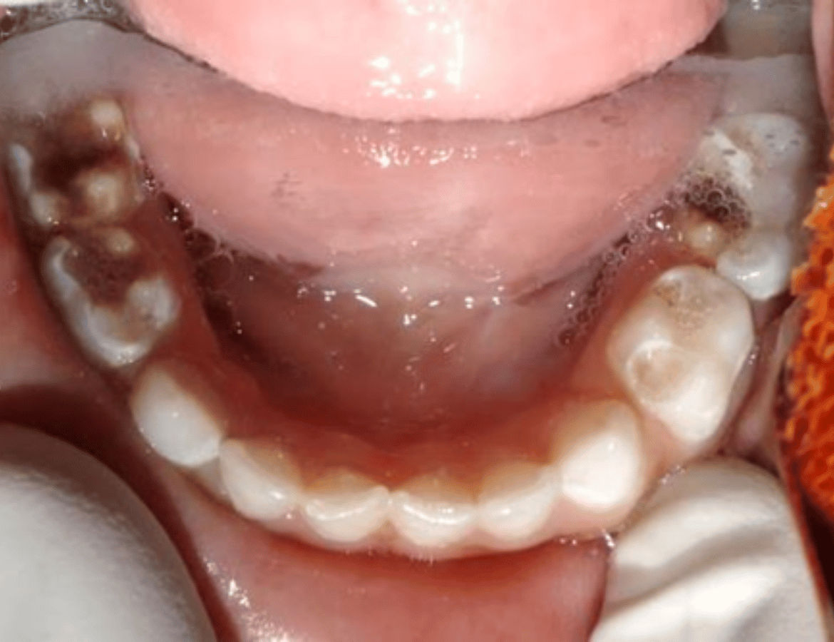 Complete Oral Rehabilitation under General Anasthesia-before