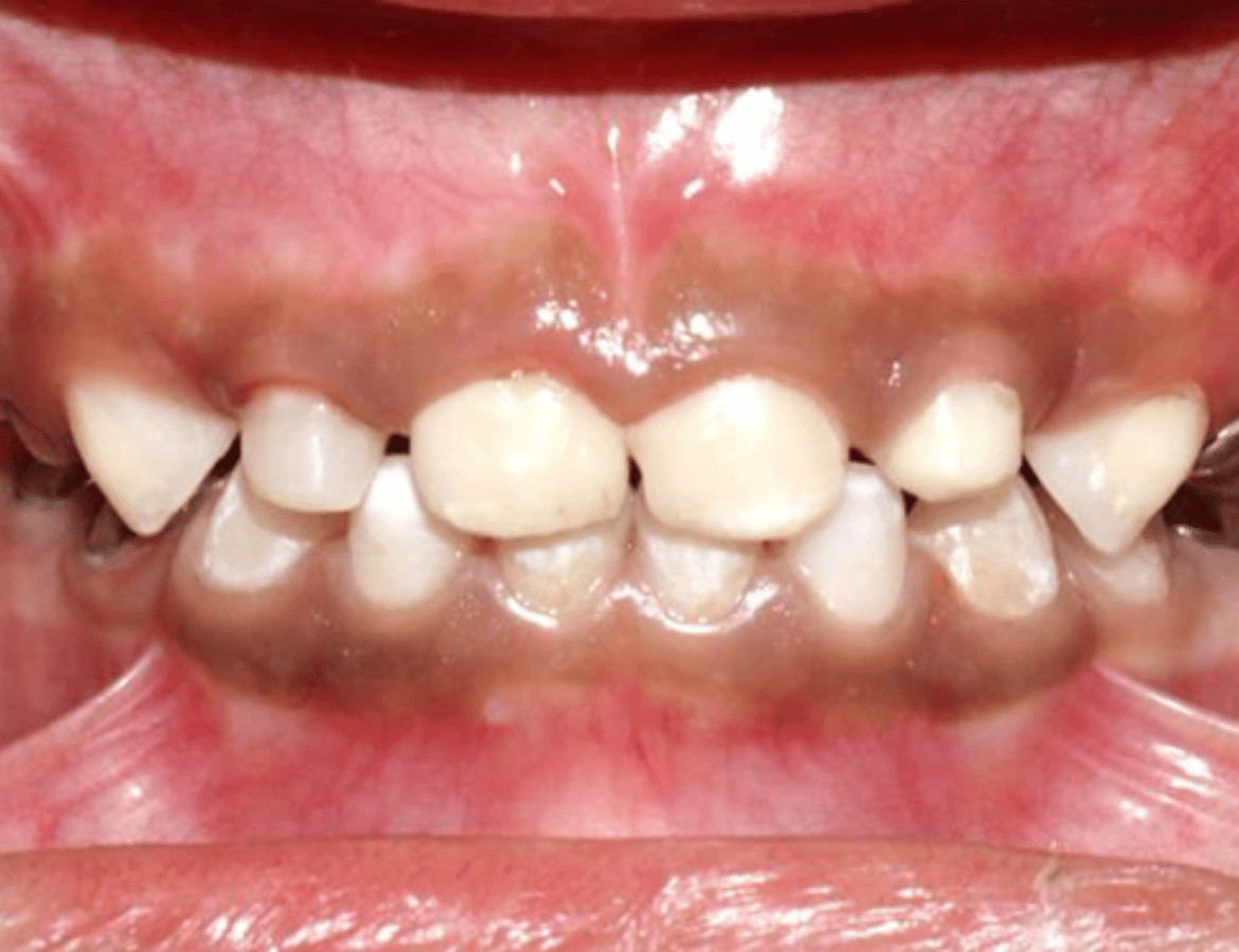 Complete dental rehabilitation-after-03