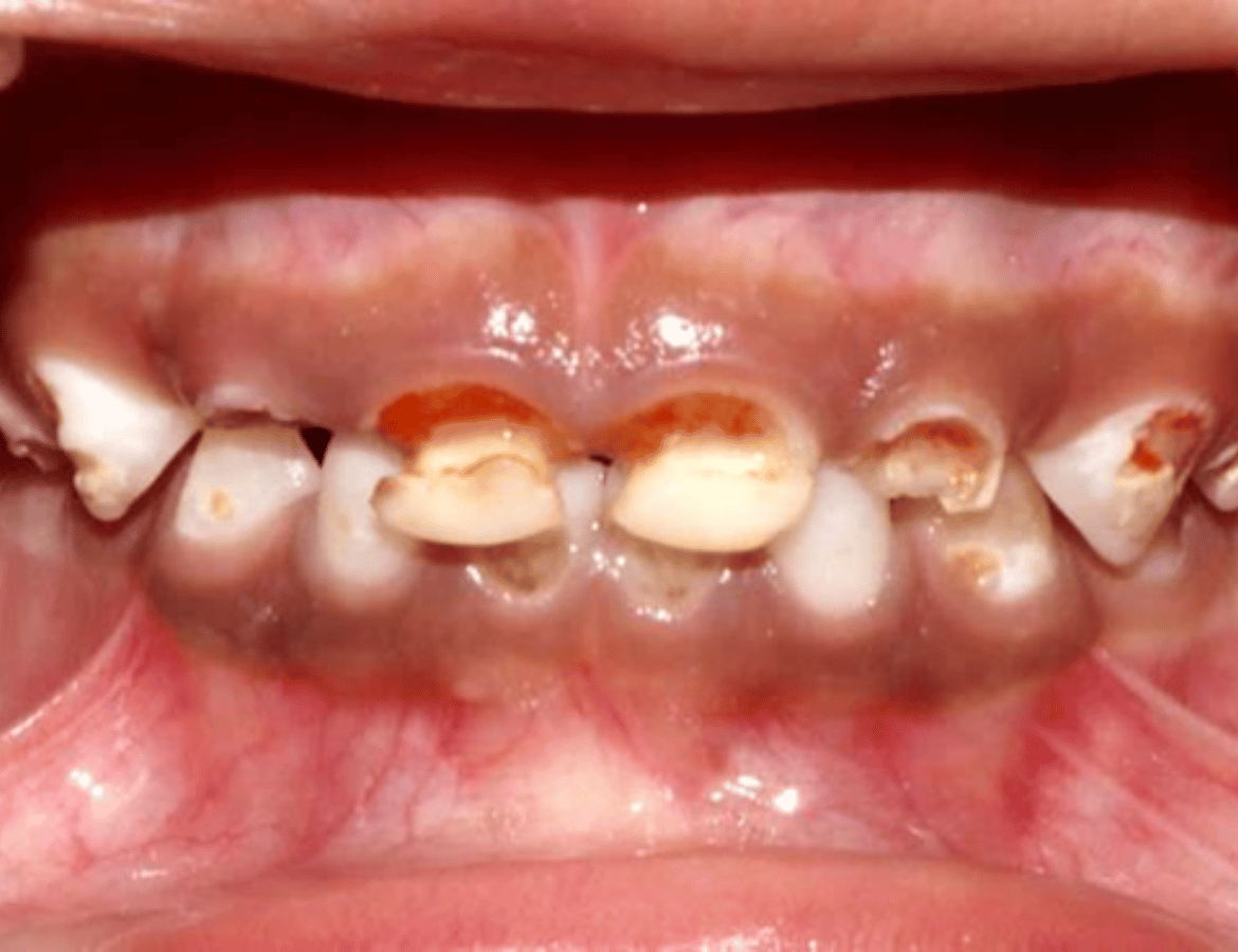 Complete dental rehabilitation-before-03