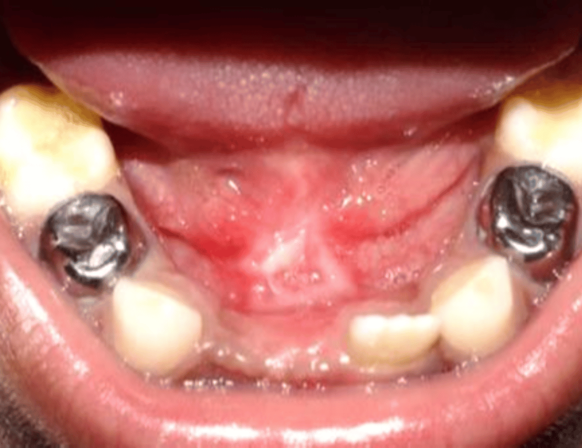 Laser Frenectomy-after