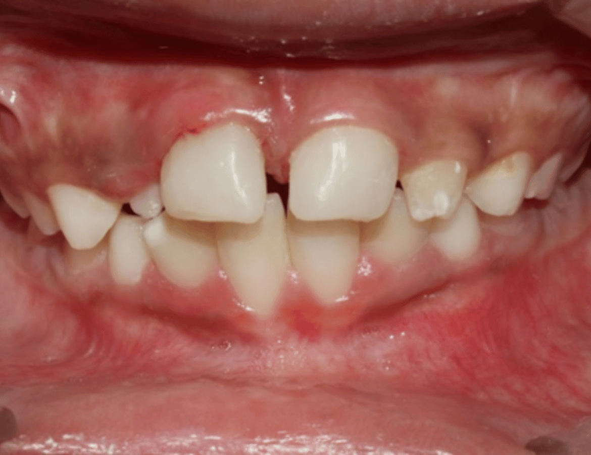 Management of Multiple fracture in front teeth - after